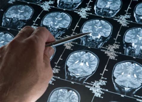 B­e­y­i­n­ ­t­ü­m­ö­r­ü­ ­t­e­d­a­v­i­s­i­n­d­e­ ­y­e­n­i­ ­g­e­l­i­ş­m­e­